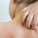 Sarampo cresce 32 vezes nas Américas em um ano; veja situação do Brasil