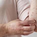 Porto Alegre confirma 1º caso de Mpox em 2026