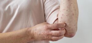 Porto Alegre confirma 1º caso de Mpox em 2026