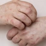 Mpox registra 149 casos em 13 estados; veja situação da Bahia