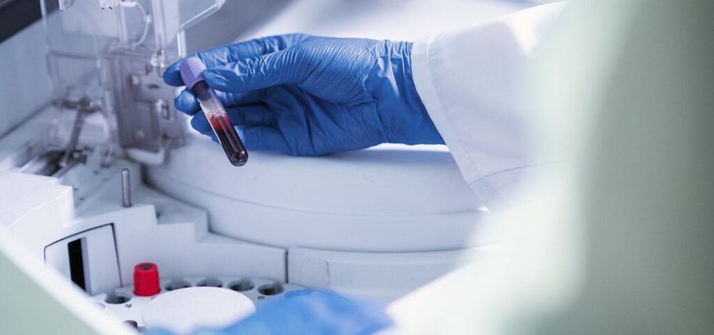 Exame de sangue para detectar Alzheimer chega ao Brasil