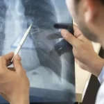 Anvisa aprova novo medicamento para câncer de pulmão avançado